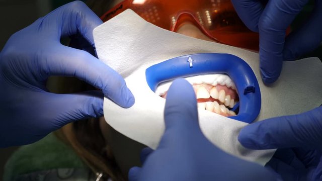 Modern dental clinic concept. Top view. Preparation for professional cosmetic teeth whitening in dentist clinic. Female patient in dental office on chair. Teeth whitening procedure.. Close-up. 4 k