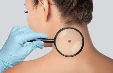 The doctor examines a large mole on the shoulder with a magnifying glass in the clinic. Cosmetology...