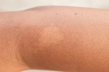 The arm with white birthmark.Birthmark on the arm of Southeast Asian child.