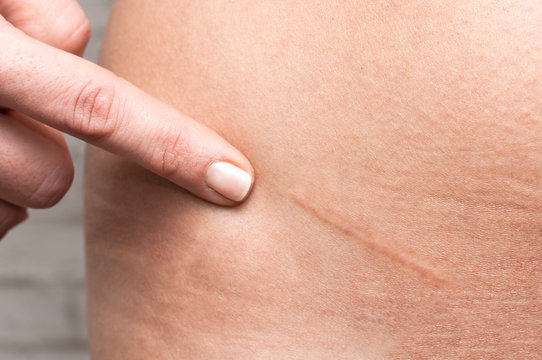 Scars Изображения: просматривайте стоковые фотографии, векторные изображения и в
