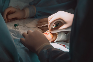 surgery on vessels; process of operation; surgery room; doctors on heart surgery; hospital