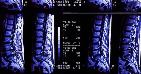 Magnetic resonance imaging of a patient spine with chronic back pain. The MRI shows degenerative...