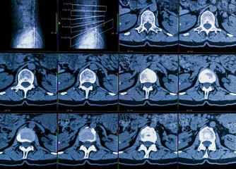 Results of computer tomography or CT imaging of human spine of a patient with chronic back pain,...