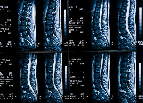 Results of magnetic resonance imaging of a patient spine with chronic back pain. The MRI shows degenerative changes of spines, lumbar discs herniation and nerve roots compression.