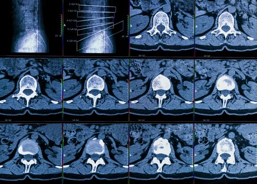 Results of computer tomography or CT imaging of human spine of a patient with chronic back pain, shows degenerative changes of spines, lumbar discs herniation and nerve roots compression