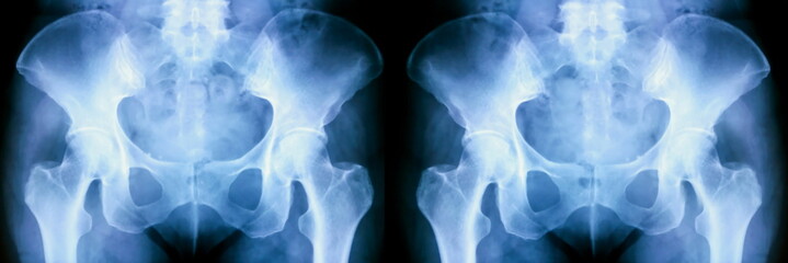 Set of X-ray of human pelvic bones