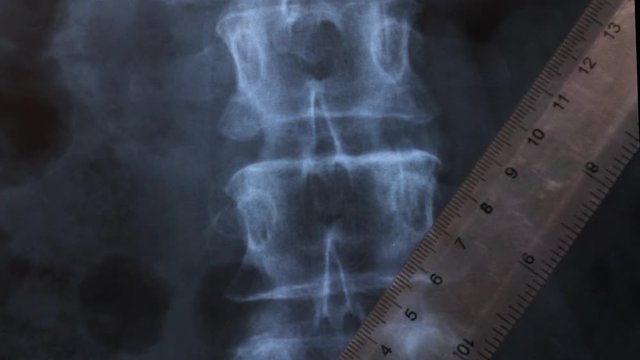 Doctor studying X-ray of the bones of the human vertebral column , 4K