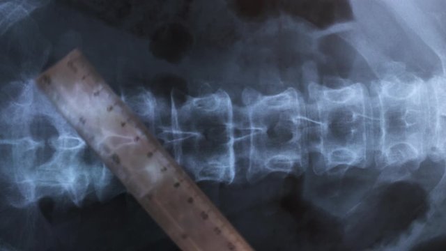 Doctor studying X-ray of the bones of the human vertebral column , 4K