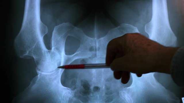 Doctor studying X-ray of pelvic bones , 4K