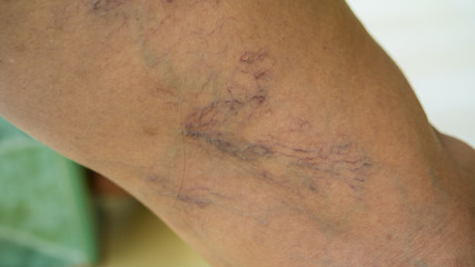 Varicose veins on young women legs