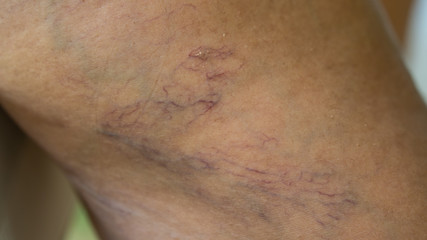 Fototapeta premium Varicose veins on young women legs
