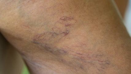 Fototapeta premium Varicose veins on young women legs