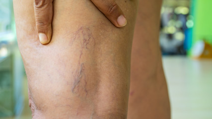 Fototapeta premium Varicose veins on young women legs