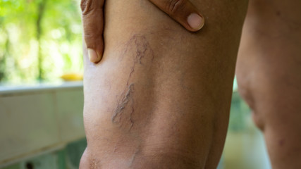 Fototapeta premium Varicose veins on young women legs