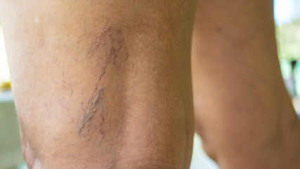 Varicose veins on young women legs