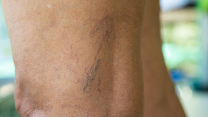 Fototapeta premium Varicose veins on young women legs