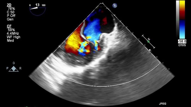 Transesophageal ultrasound video in Doppler mode.