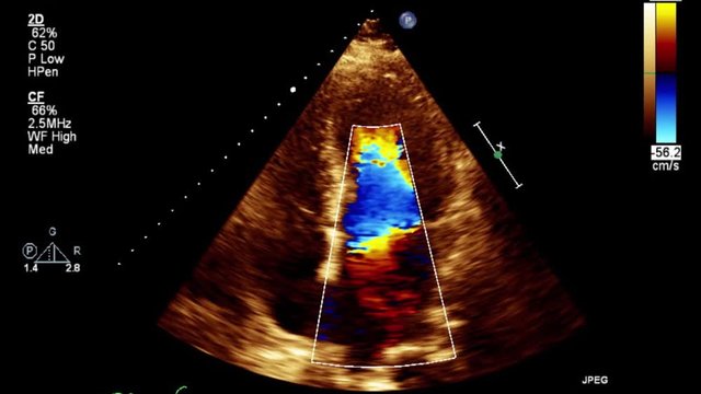 Transesophageal ultrasound video in Doppler mode.
