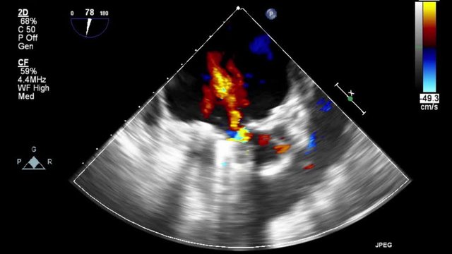 Transesophageal ultrasound video in Doppler mode.