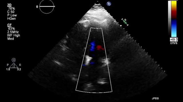 Transesophageal ultrasound video in Doppler mode.