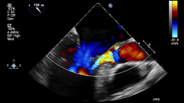 Transesophageal ultrasound video in Doppler mode.