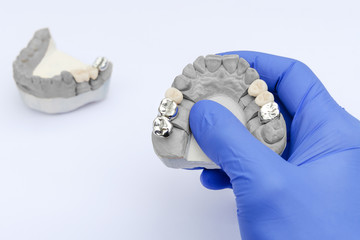 fake teeth. metal and ceramic crowns and bridges. the dentist's hand holds a plaster model. concept of orthopedic dentistry © Vladyslav Senchenko