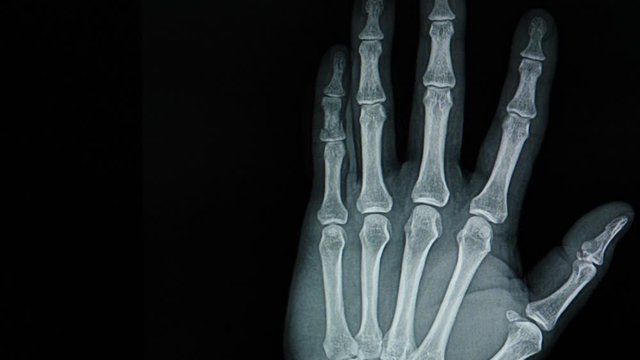Slow moving image of fracture bone.  Xray showing fracture distal phalanx of fifth finger of a patient from accident.