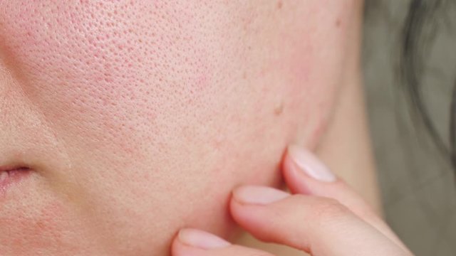 Macro skin with enlarged pores. The girl touches the irritated red skin with her fingers. Allergic reaction, peeling, care for problem skin. Beauty and cosmetology.