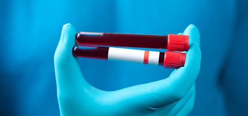 Coronavirus 2019-nCoV Blood Sample.