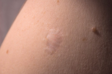 Fototapeta premium Skin problems. Scar after a medical operation to remove moles on the shoulder.