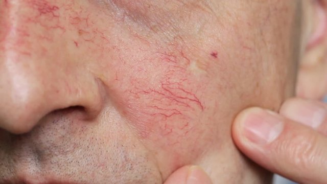 Man's face skin with vascular stars and couperose. Close up view of capillaries on the skin, telangiectasias