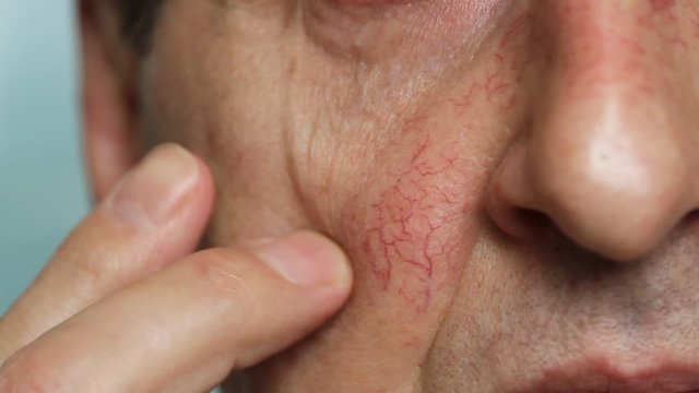Man's face skin with vascular stars and couperose. Close up view of capillaries on the skin, telangiectasias
