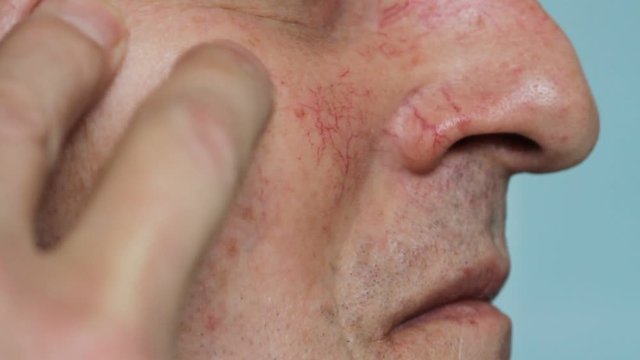 Man's face skin with vascular stars and couperose. Close up view of capillaries on the skin, telangiectasias