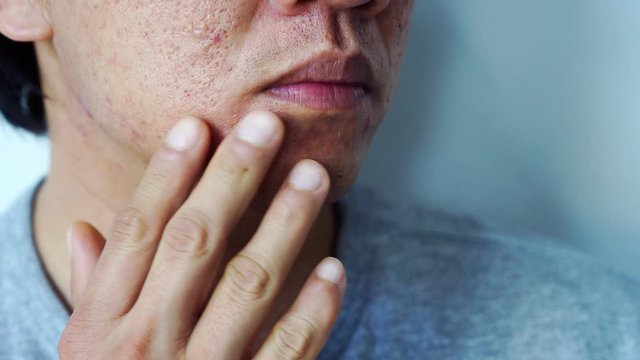 Young asian man with problematic from acne