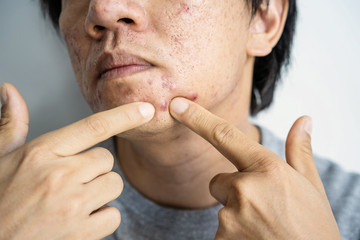 Young asian man with problematic from acne
