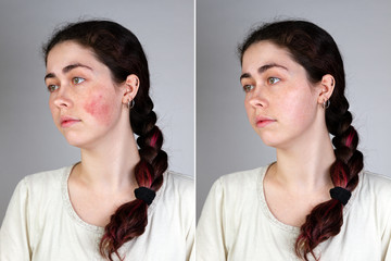 Portrait of a young Caucasian woman showing redness and inflamed blood vessels on her cheeks and...