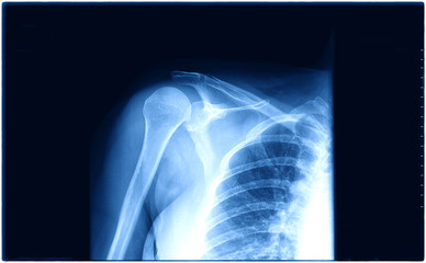 X-ray of shoulder joint / Many others X-ray images