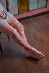 View of leg and foot with Psoriasis