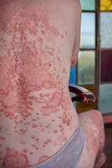 Woman's back with psoriasis