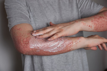 Applying moisturizer to skin with psoriasis