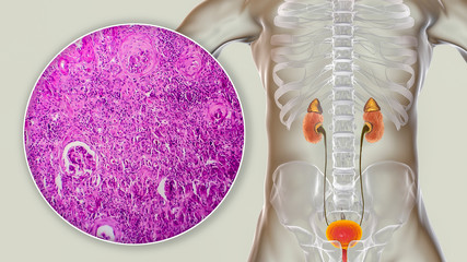 Chronic glomerulonephritis, gross pathology