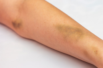 Female hand bruised after male abuse.