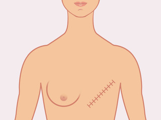 Female human form illustrated with the scars of a mastectomy - obrazy, fototapety, plakaty