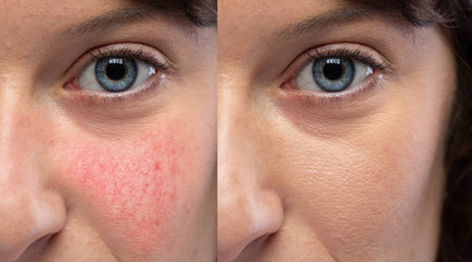 Collage comparing healthy skin and face suffering rosacea, visible blood vessels and capillaries....