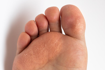 Detail of adult rough skin and foot corn callosity. Footwear problem concept