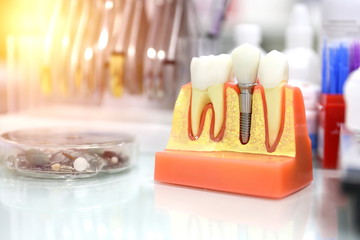 concept of dental implant. dental implant model is on dentist table with glare