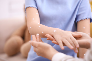Obraz na płótnie Canvas Mother applying cream onto skin of her daughter with chickenpox at home, closeup