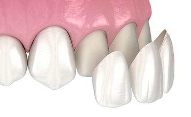 Veneer installation procedure over central incisor and lateral incisor. Medically accurate tooth 3D illustration