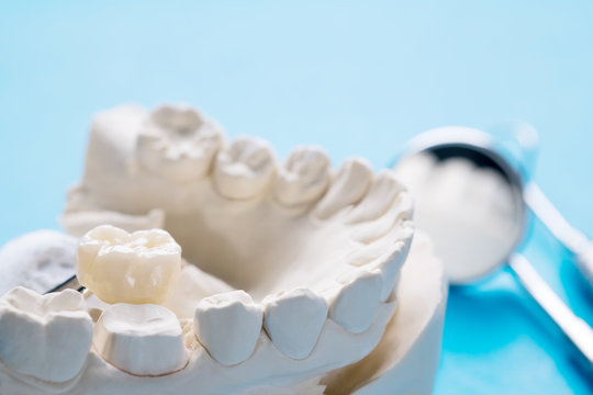 Closeup / Prosthodontics or Prosthetic / Single teeth crown and bridge equipment model express fix restoration.