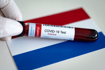 Testing for presence of coronavirus. Tube containing a blood sample that has tested positive for...